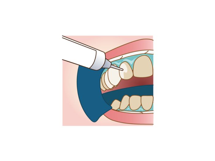 唇・歯茎の保護