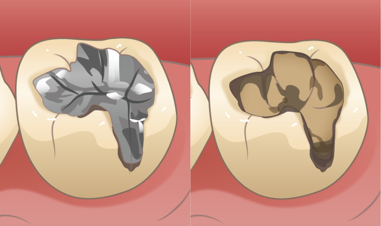 二次カリエス|南栗橋歯科