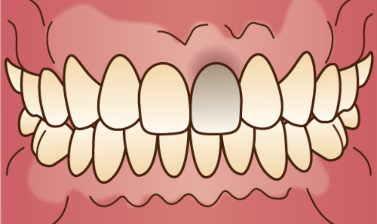メタルタトゥー|南栗橋歯科