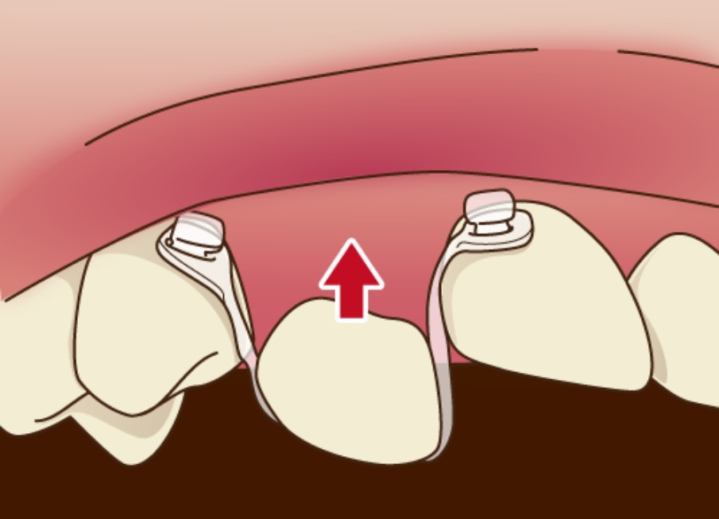 MTM(部分矯正)|南栗橋歯科