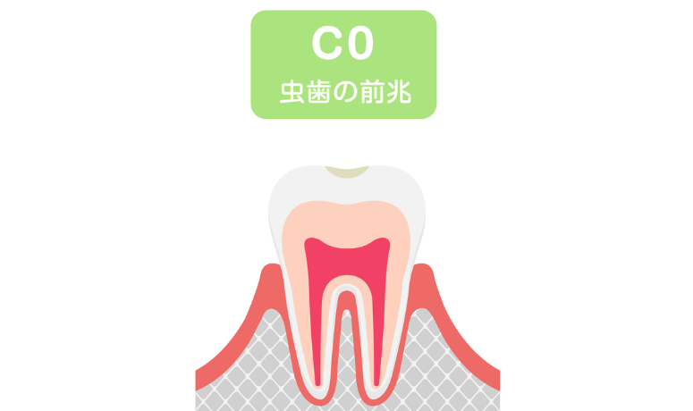 虫歯の前兆|南栗橋歯科