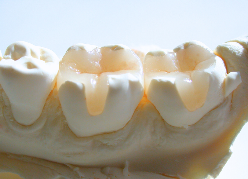 インレー修復|南栗橋歯科