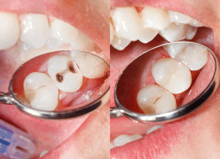 コンポジットレジン充填|南栗橋歯科