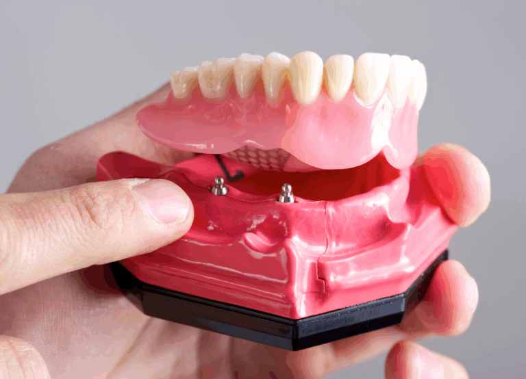 ロケーター義歯|南栗橋歯科