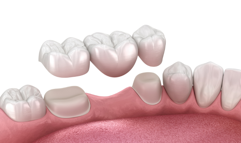 ブリッジ|南栗橋歯科