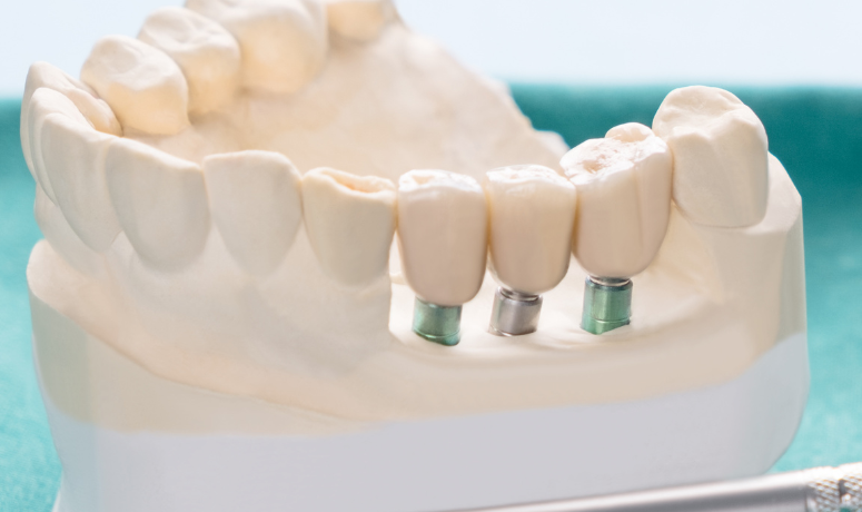 インプラント|南栗橋歯科