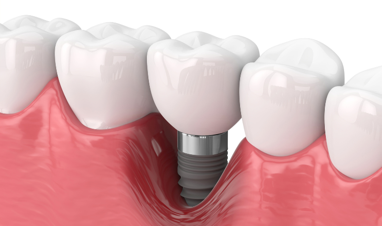 インプラント周囲炎|南栗橋歯科