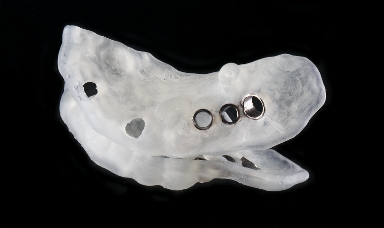 サージカルガイド|南栗橋歯科