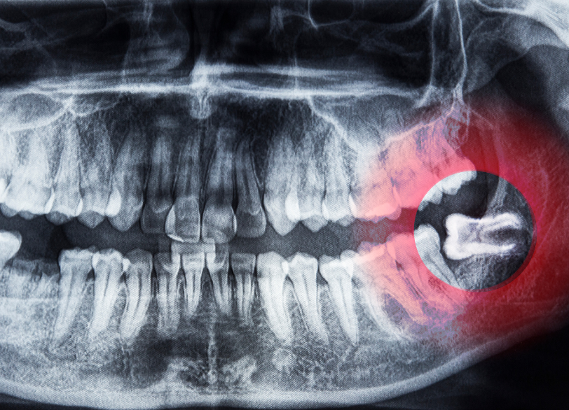 親知らずとは｜南栗橋歯科