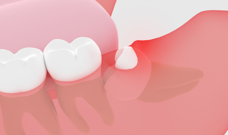 智歯周囲炎｜南栗橋歯科