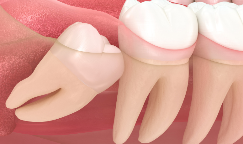 隣の歯（第二大臼歯）への悪影響｜南栗橋歯科