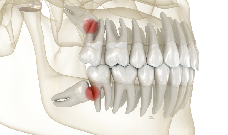 歯並びの悪化｜南栗橋歯科