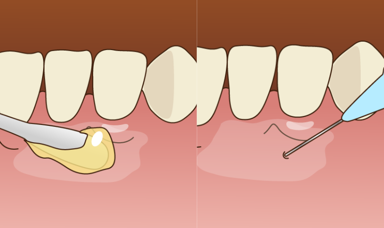 痛みに配慮した丁寧な麻酔と精密な処置｜南栗橋歯科