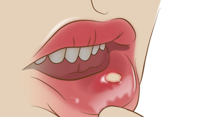 お口の中の「できもの」（口腔粘膜疾患）｜南栗橋歯科