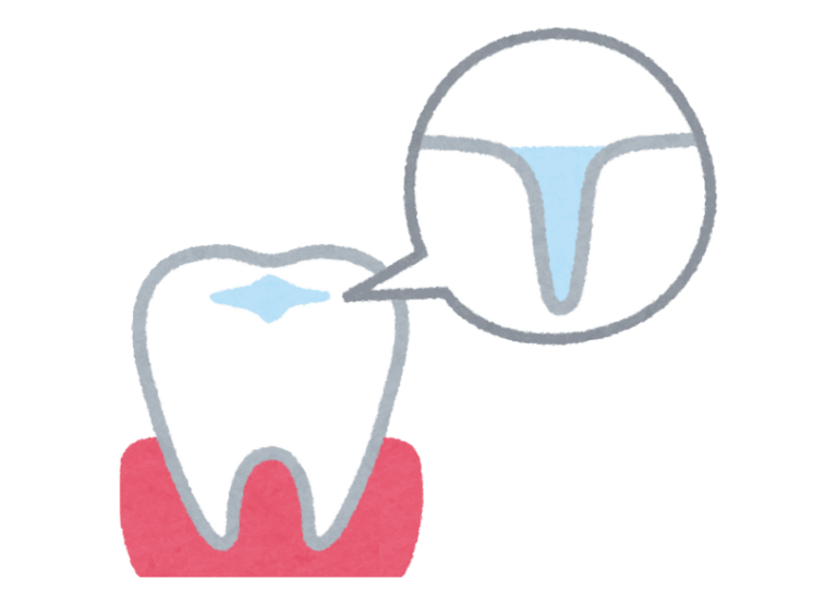 シーラント|南栗橋歯科