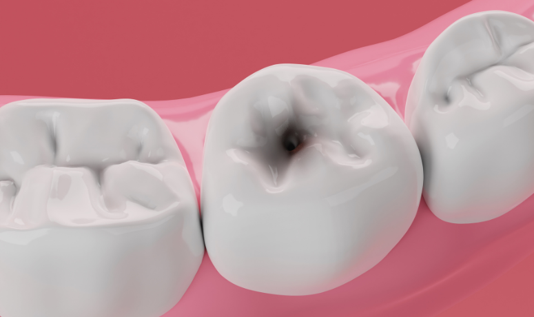 虫歯は「感染症」です|南栗橋歯科