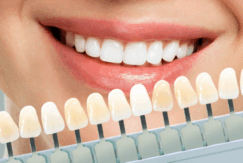 ホワイトニング(ホワイトエッセンス)