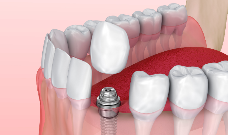 最終上部構造｜南栗橋歯科