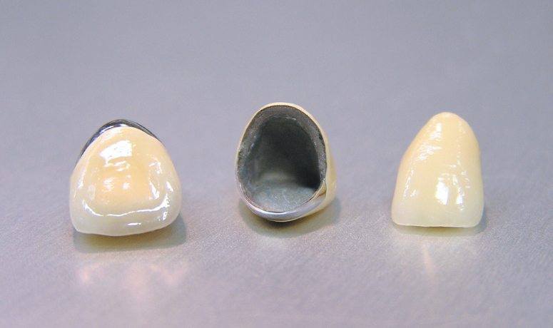 メタルボンド｜南栗橋歯科