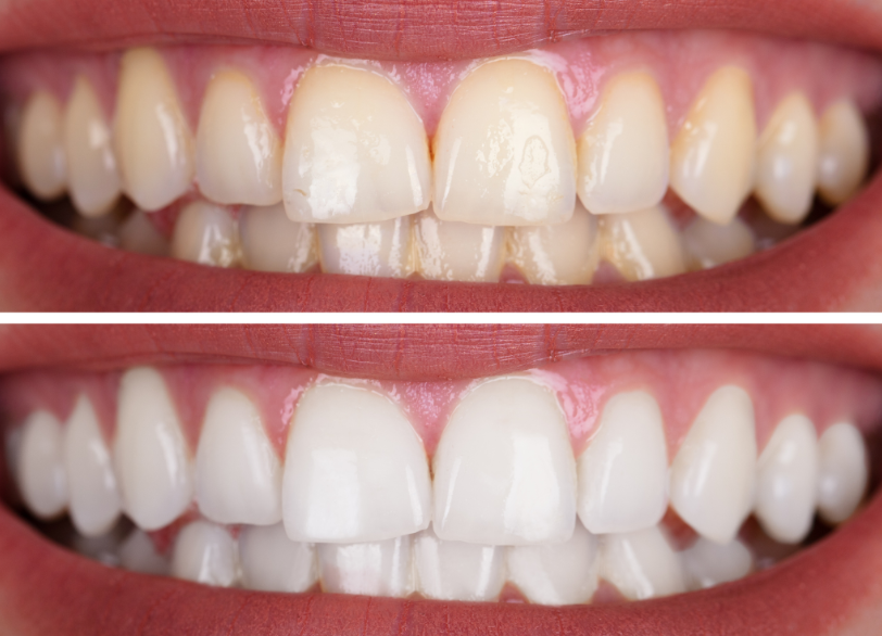 ホワイトニングの原理|南栗橋歯科