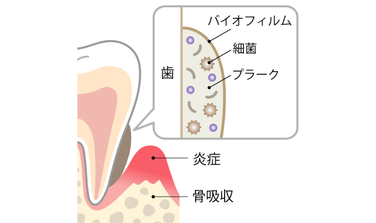 歯周病は歯を支える土台が溶けていく病気|南栗橋歯科