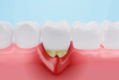 歯周病|南栗橋歯科