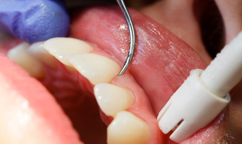 スケーリング|南栗橋歯科