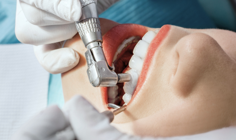 歯面の研磨(ポリッシング)|南栗橋歯科