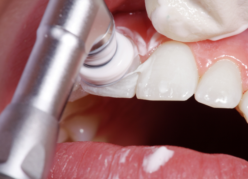 ポリッシングブラシとペースト|南栗橋歯科