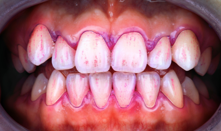 染め出し|南栗橋歯科