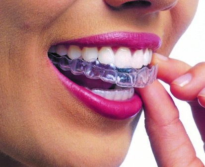 CARRY SMILE（キャリースマイル）矯正　Vol.2～歯列矯正の種類～