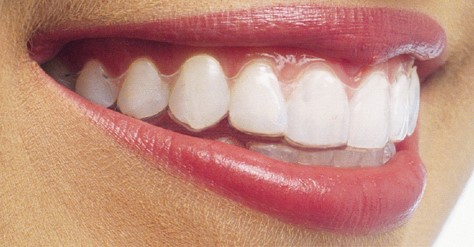 CARRY SMILE（キャリースマイル）矯正　Vol.３～アライナー矯正のメリット～