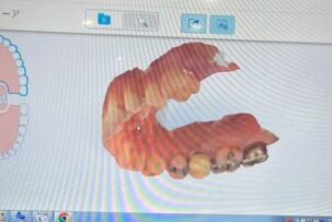 歯の型取りが、より不快感少なく！短時間で正確に！