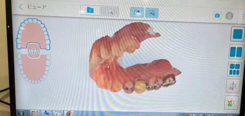歯の型取りが、より不快感少なく！短時間で正確に！