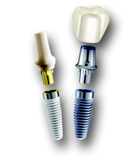 インプラントについて