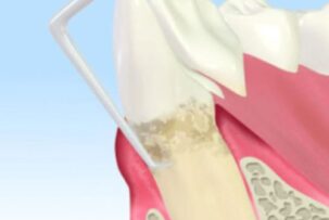 歯科検診の重要性 Vol.2～歯周病は怖い～