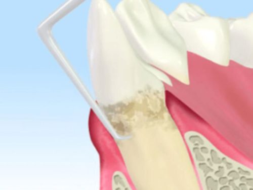 歯科検診の重要性 Vol.2～歯周病は怖い～