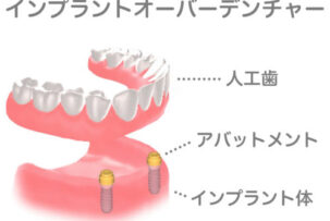 インプラントvol3　インプラントを考えるタイミング