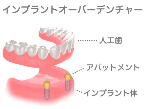 インプラントvol3　インプラントを考えるタイミング
