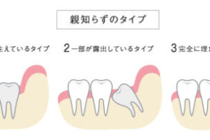 親知らずの抜歯に関して