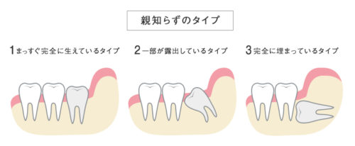 親知らずの抜歯に関して